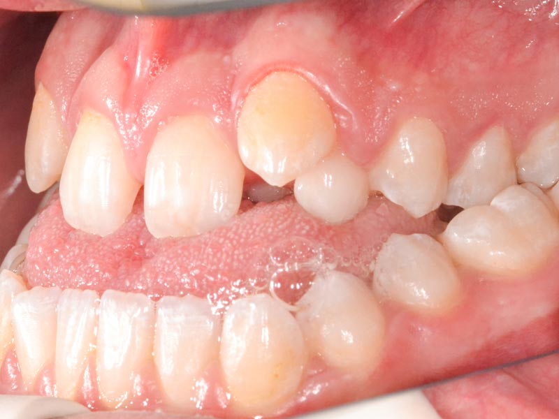 ortognatica-ortodoncia-antes