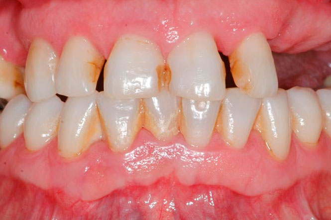 protesis-fija-sobre-implantes-antes