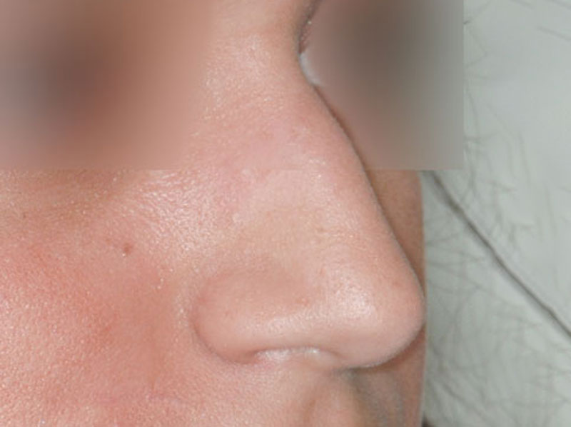 rinoplastia-antes