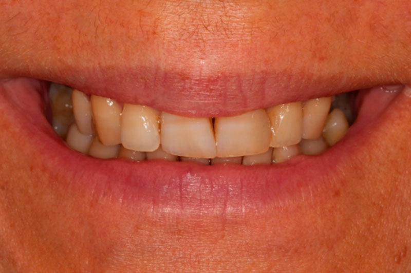 caso-carillas-implantes-dentales-antes